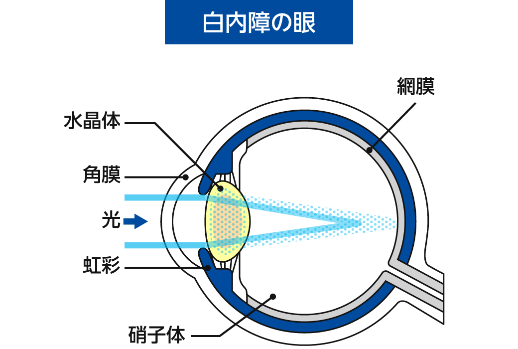 白内障の眼