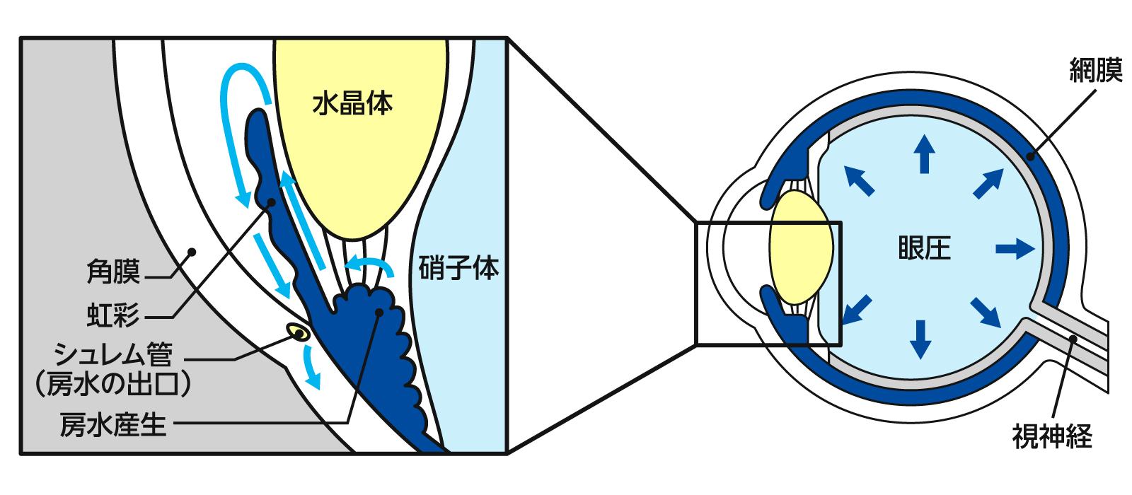 緑内障