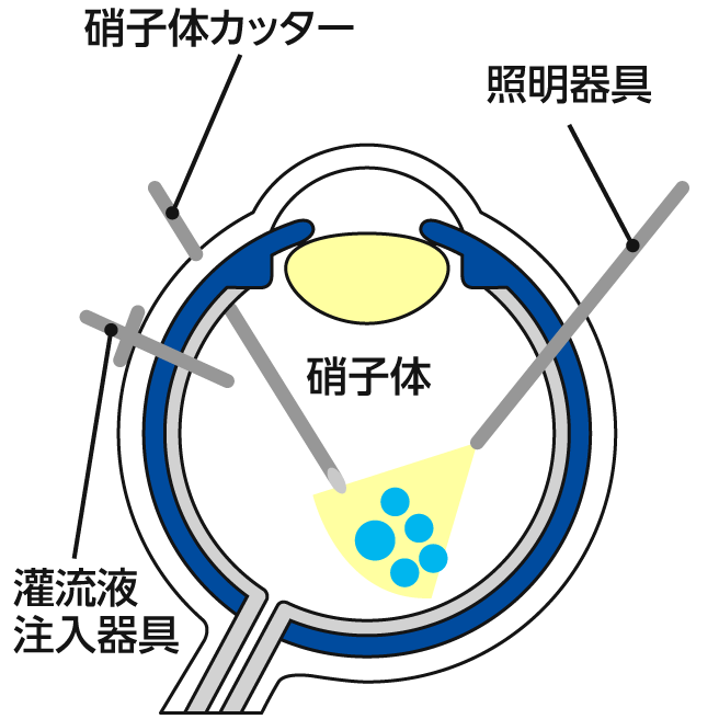 白目部分に小さな穴をあける