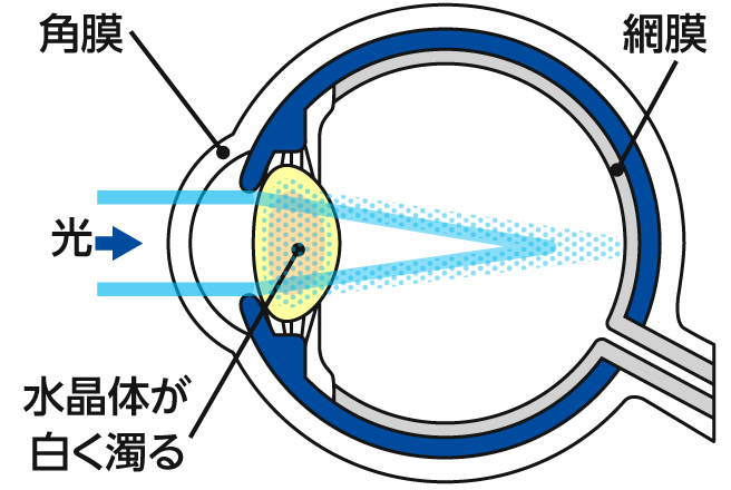 白内障の症状