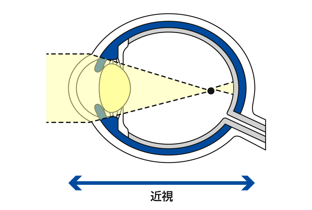 近視
