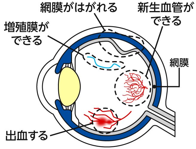 糖尿病網膜症