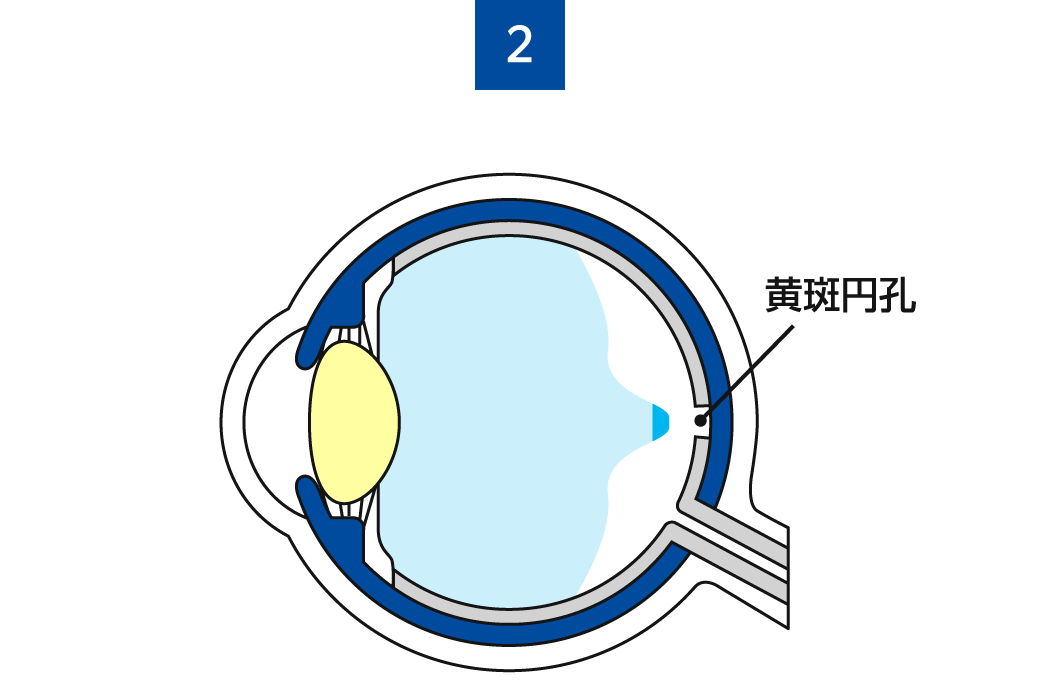 黄斑円孔2