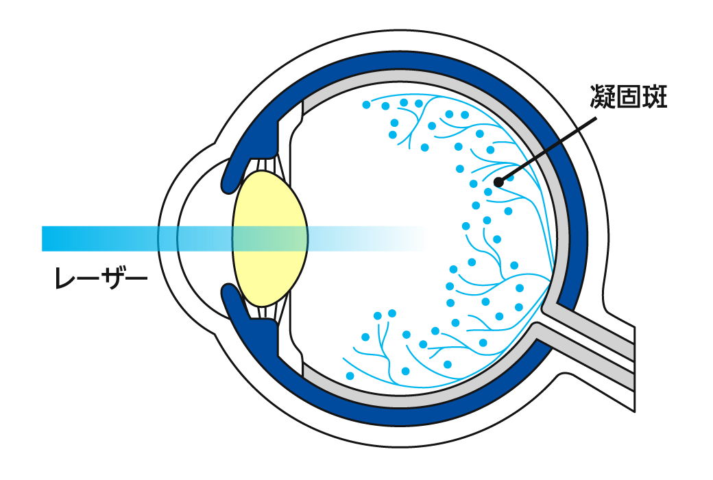 網膜光凝固術 イラスト