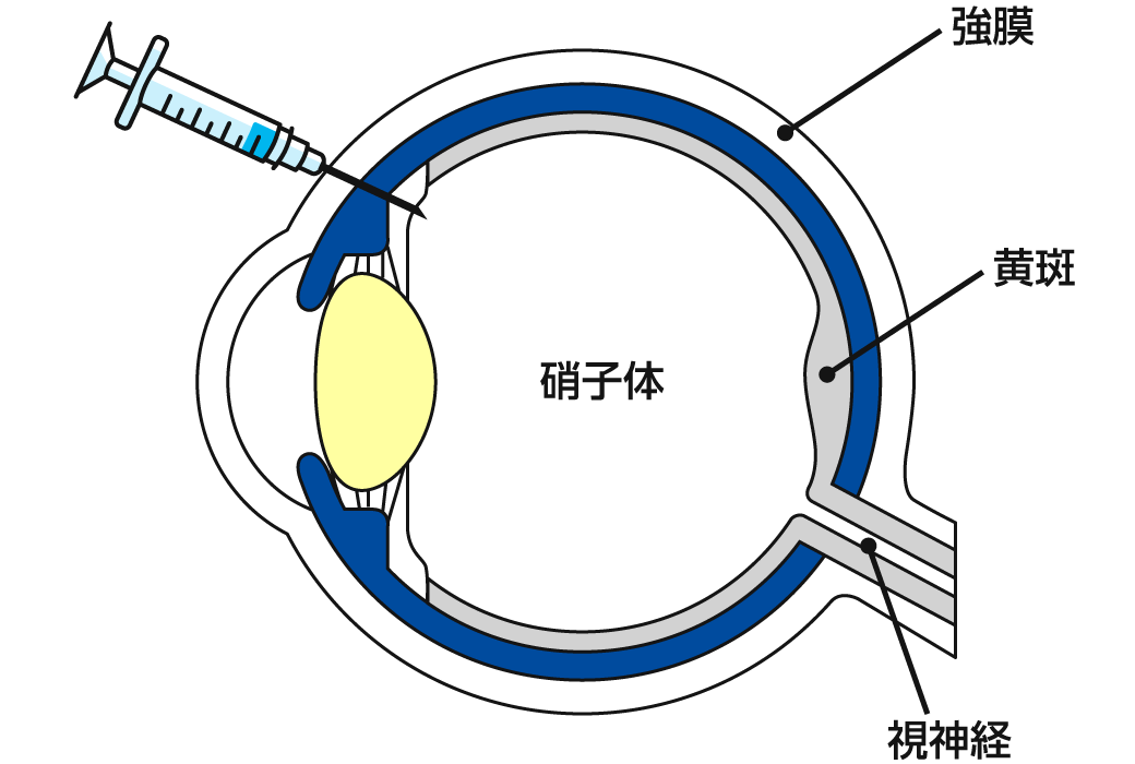 抗VEGF薬の働き