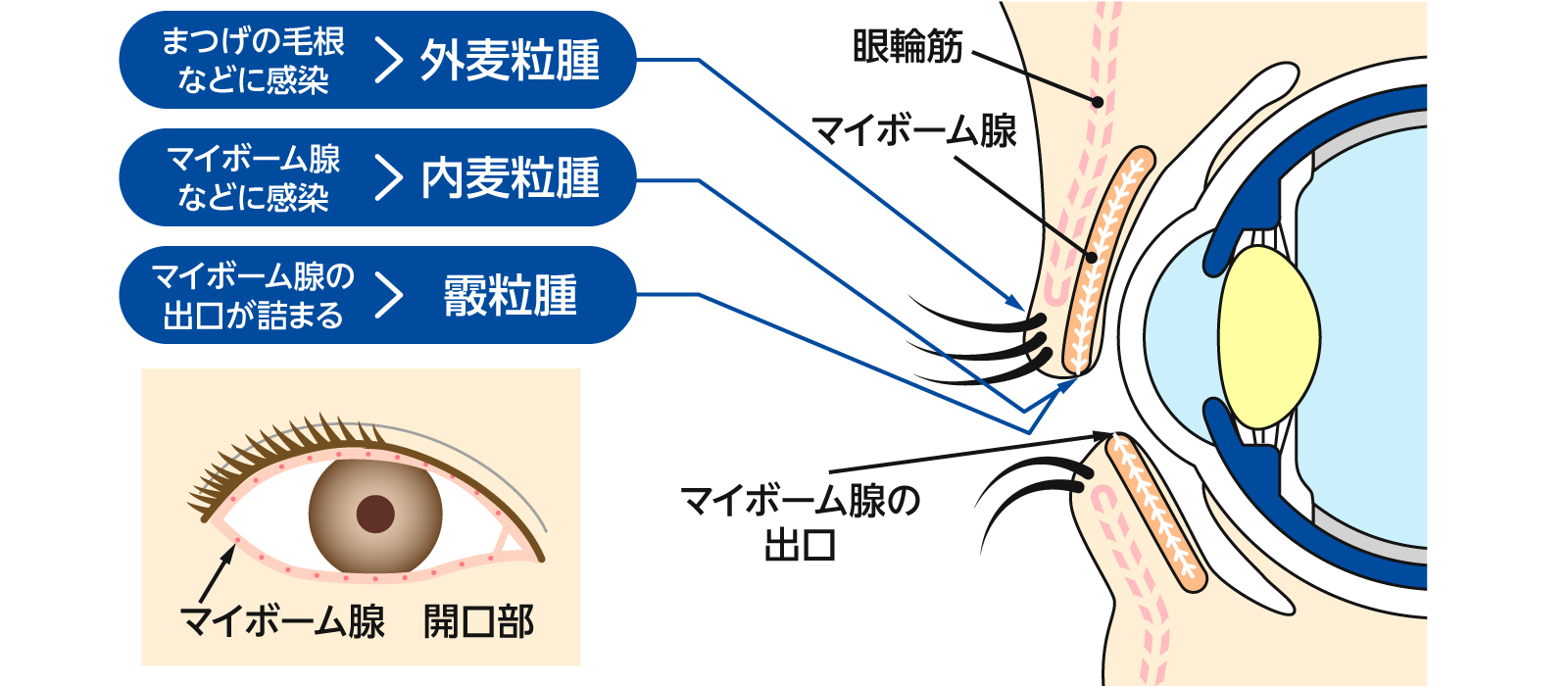 麦粒腫／霰粒腫