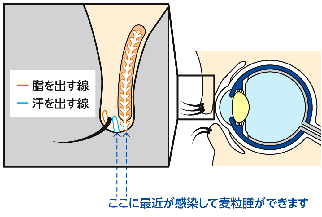 麦粒腫